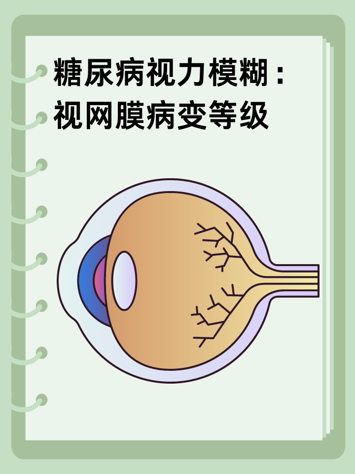 👉糖尿病视力模糊：视网膜病变等级