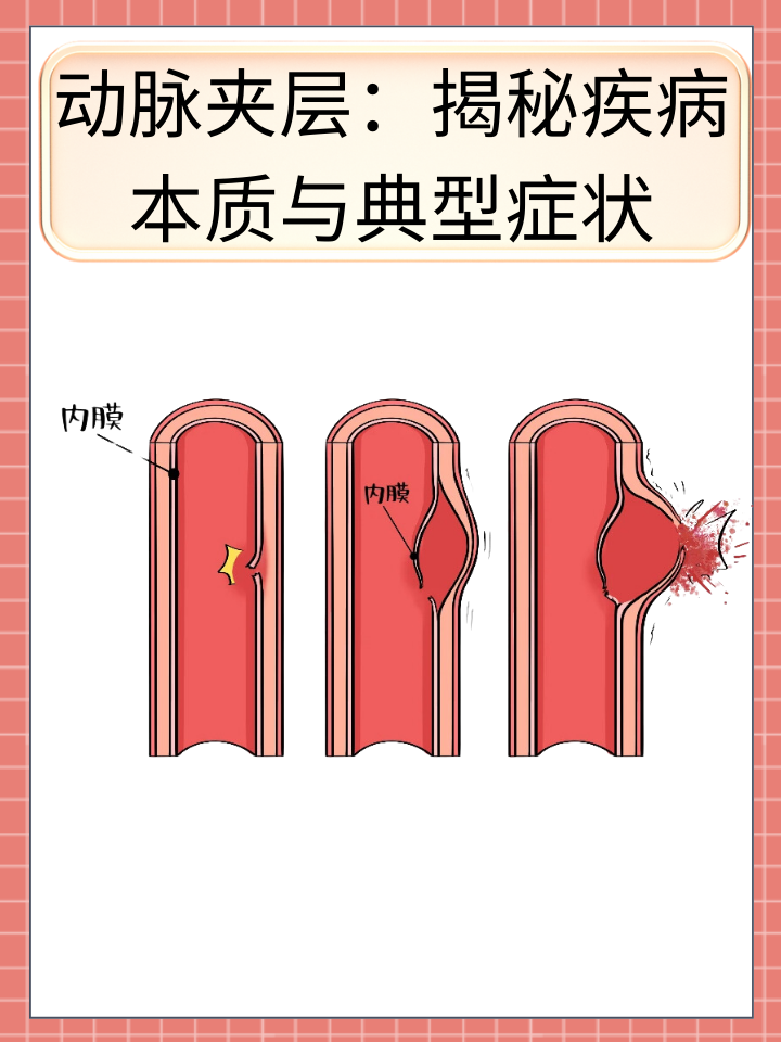 👉动脉夹层：揭秘疾病本质与典型症状