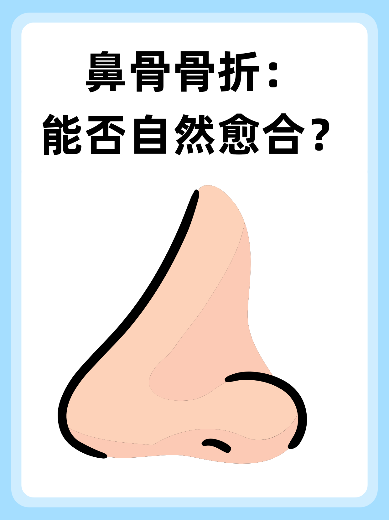 👉鼻骨骨折：能否自然愈合？