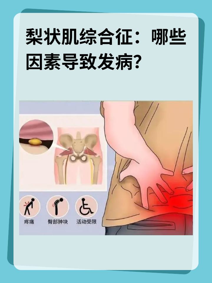 👉梨状肌综合征：哪些因素导致发病？