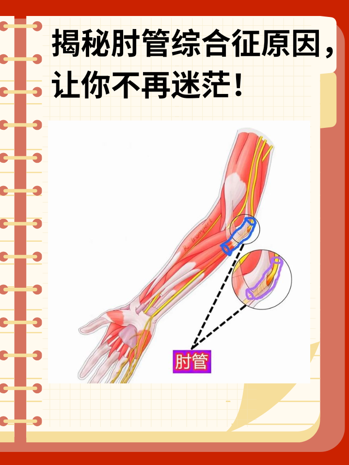 👉揭秘肘管综合征原因，让你不再迷茫！