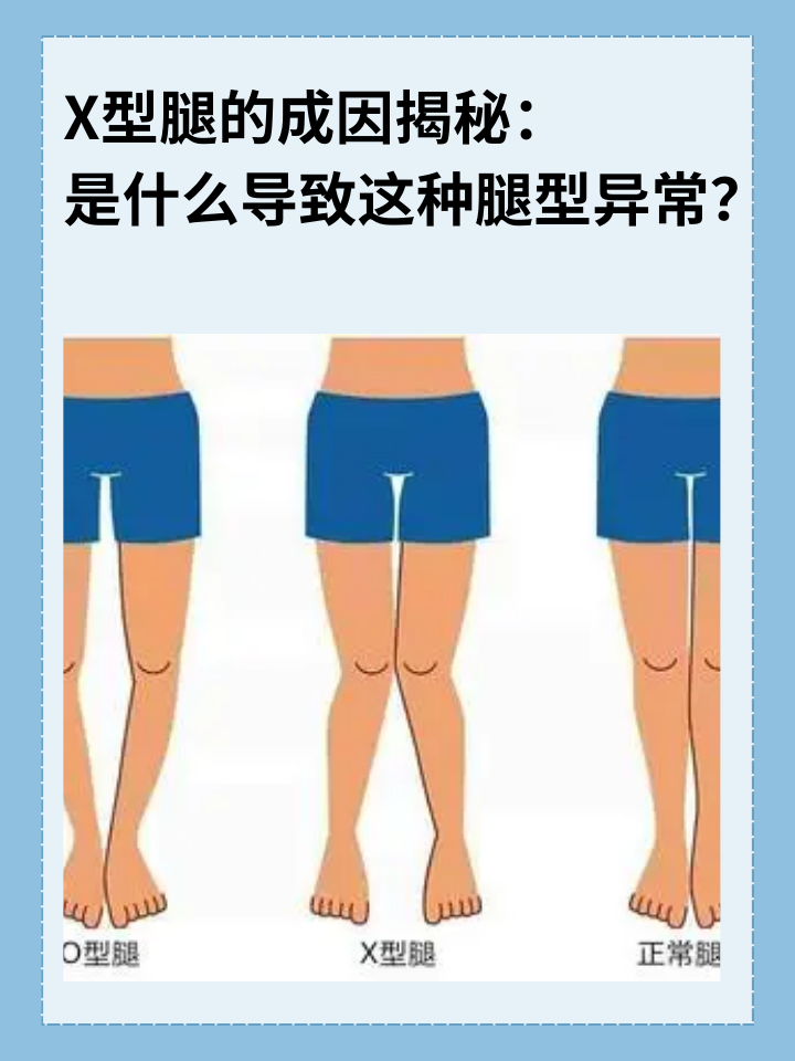 👉X型腿的成因揭秘：是什么导致这种腿型异常？