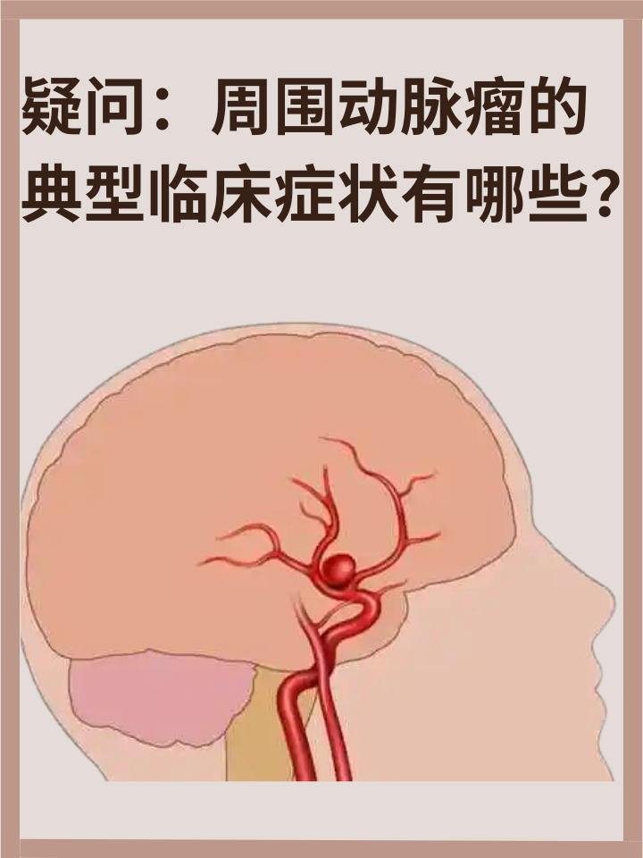 👉疑问：周围动脉瘤的典型临床症状有哪些？