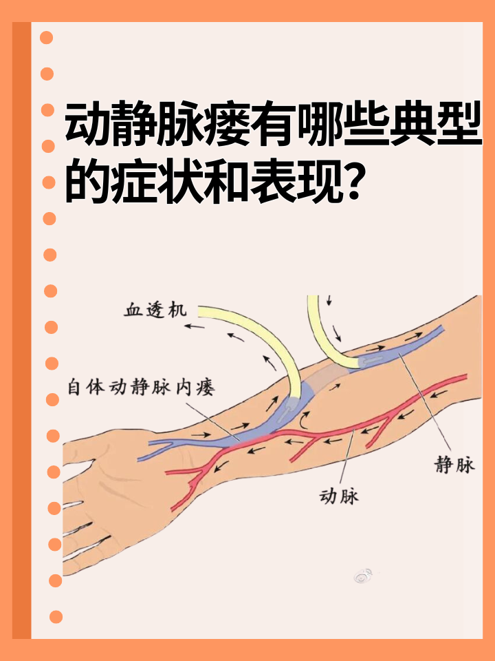 👉动静脉瘘有哪些典型症状和表现？