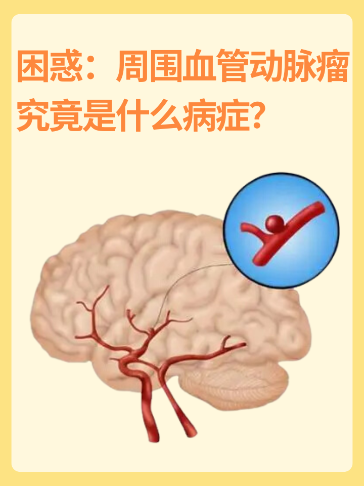 👉困惑：周围血管动脉瘤究竟是什么病症？