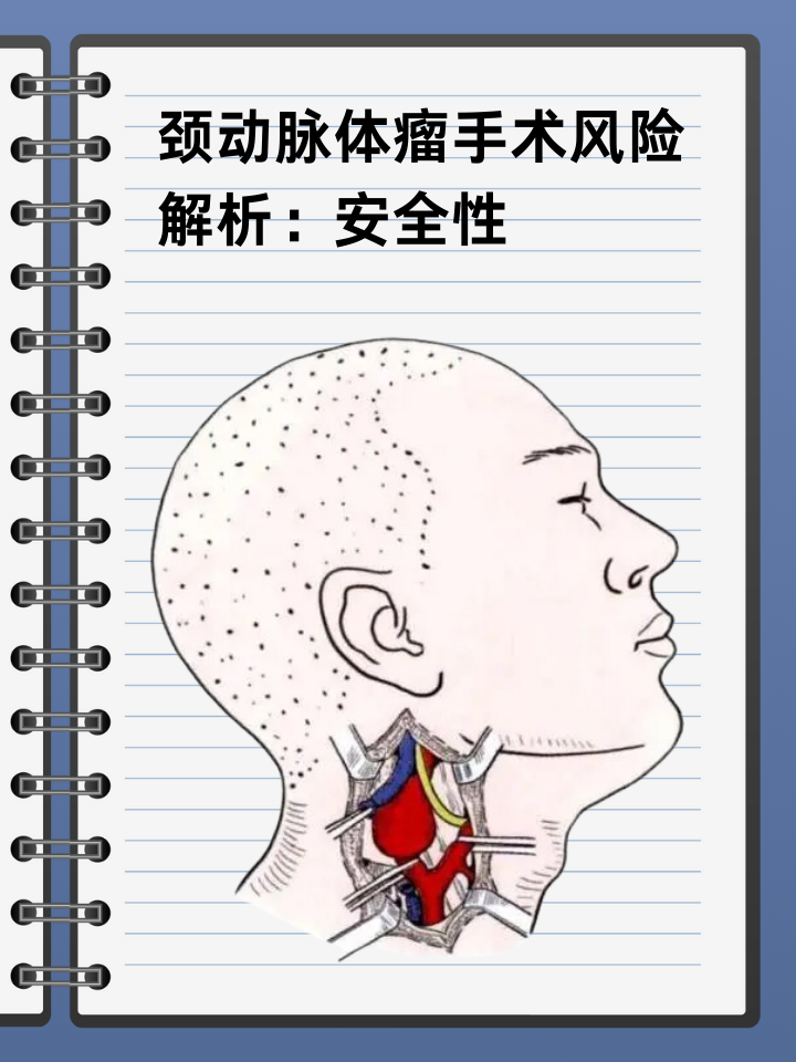 👉颈动脉体瘤手术风险解析：安全性