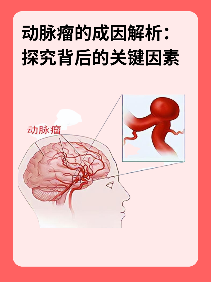 👉动脉瘤的成因解析：探究背后的关键因素