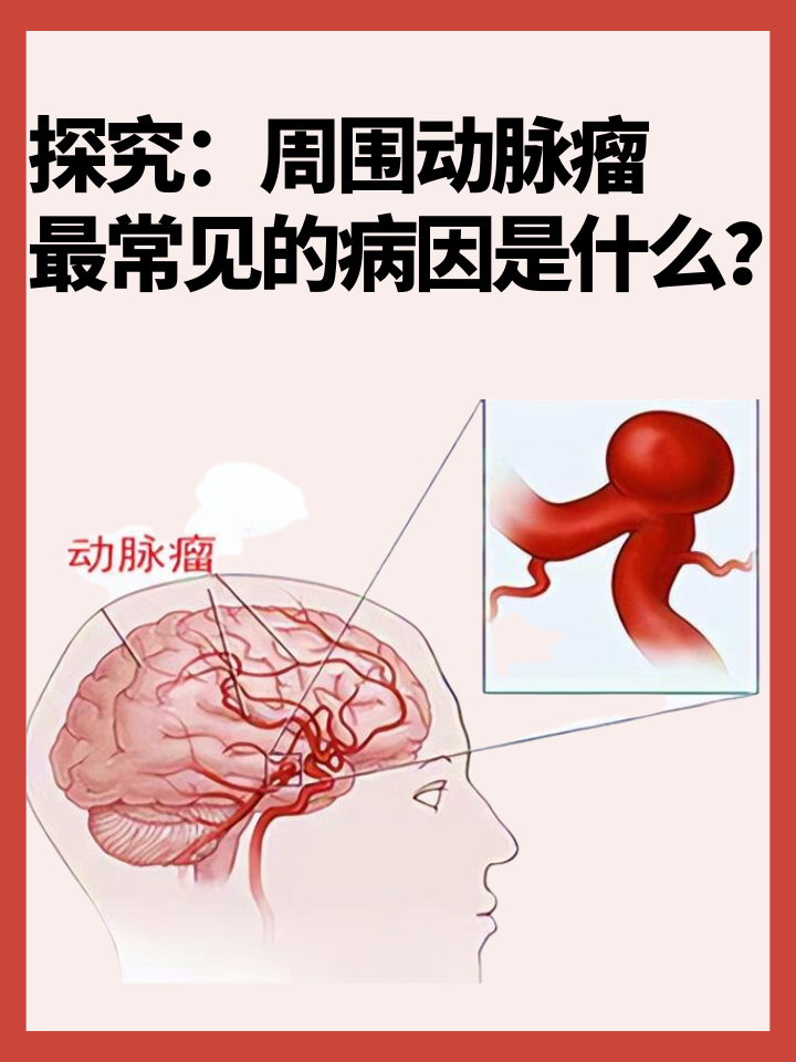 👉探究：周围动脉瘤最常见的病因是什么？