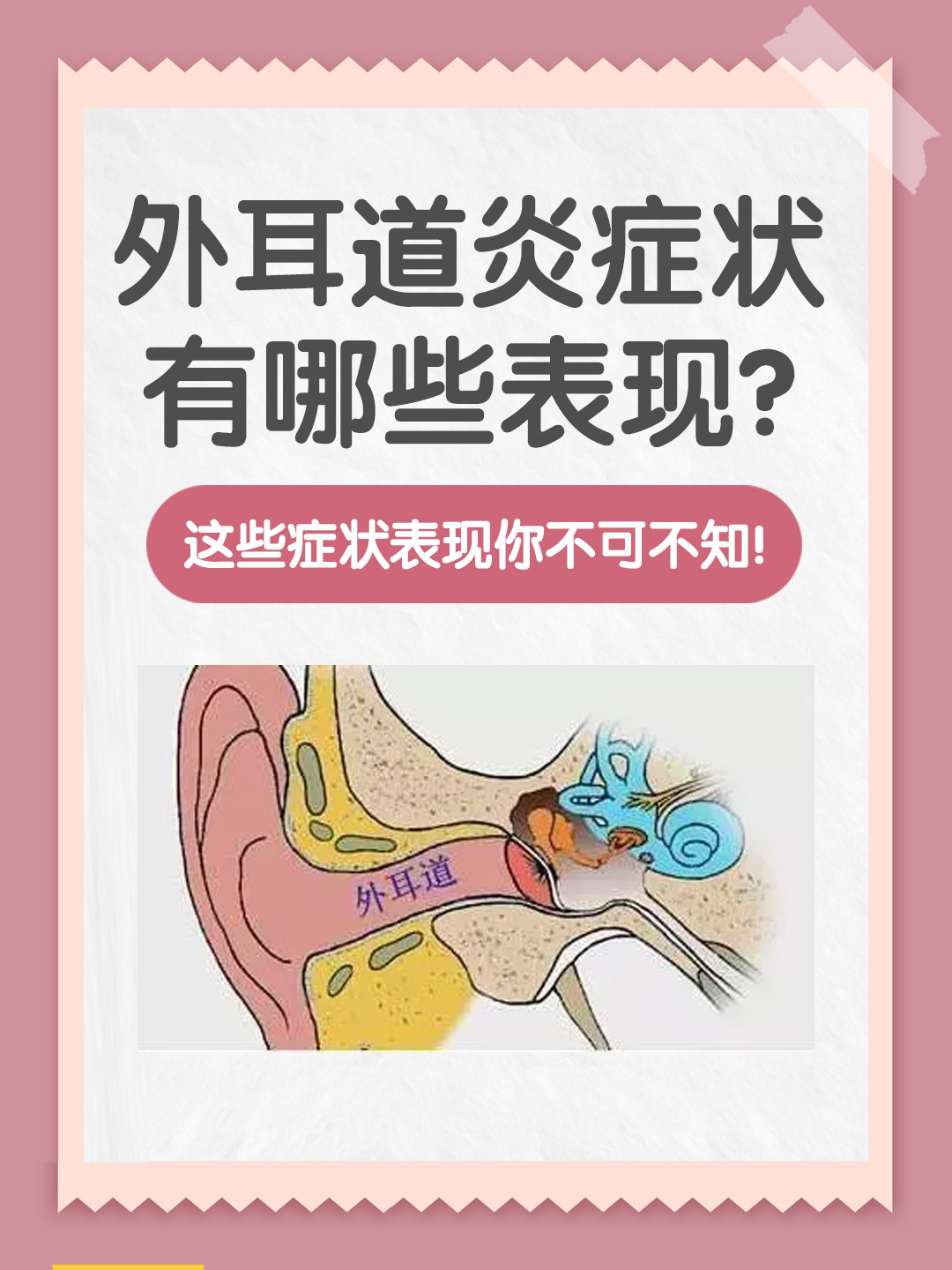 👉外耳道炎症状有哪些表现？这些症状表现你不可不知！