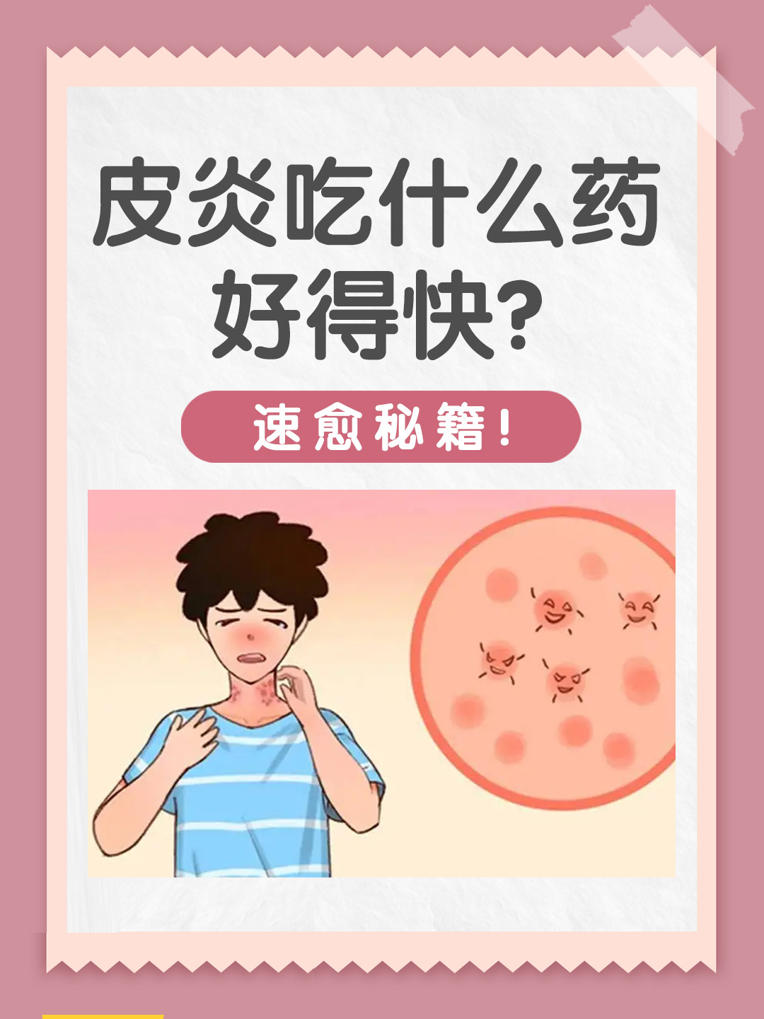 👉皮炎吃什么药好得快？速愈秘籍！