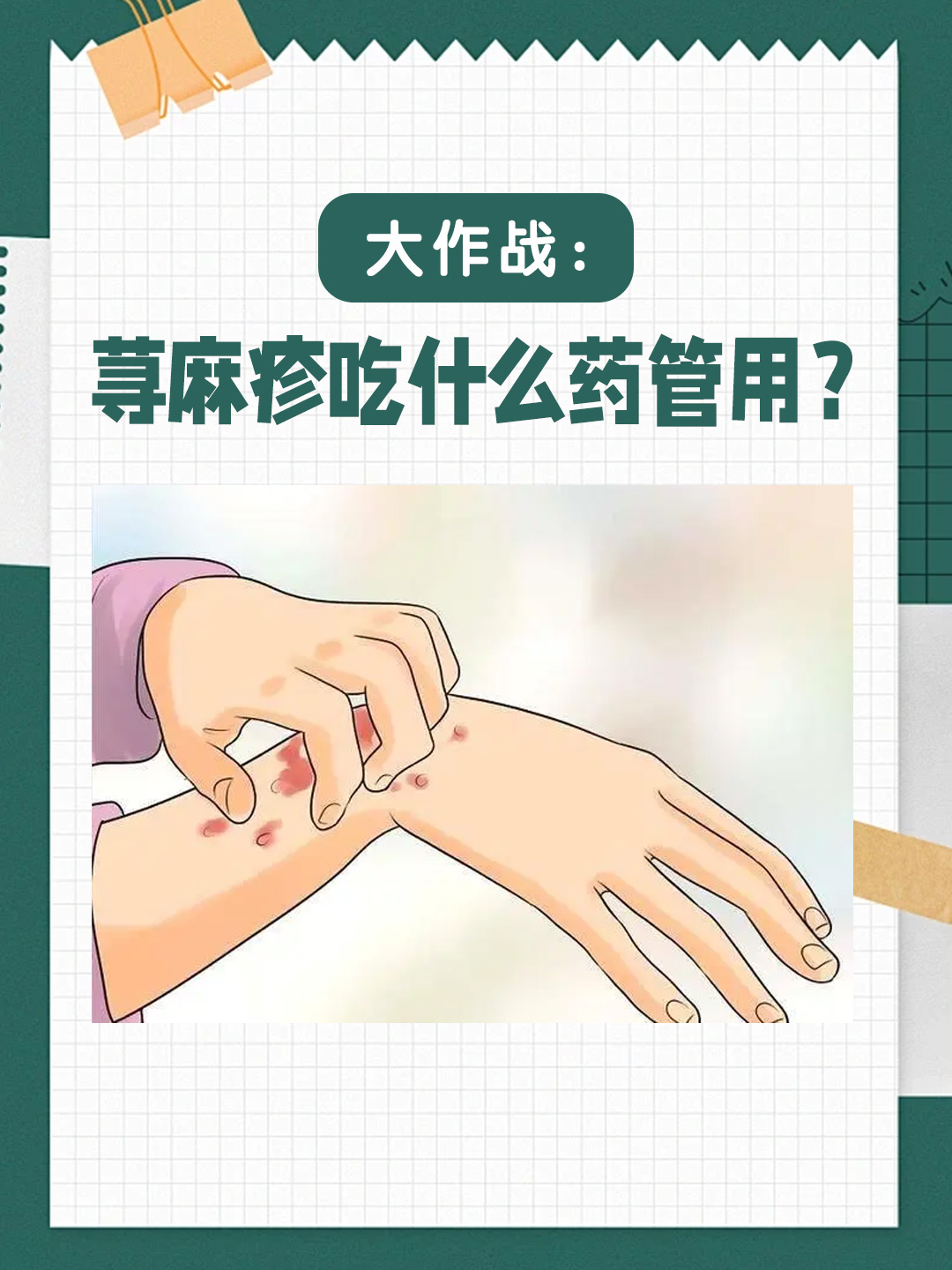 👉大作战：荨麻疹吃什么药管用？