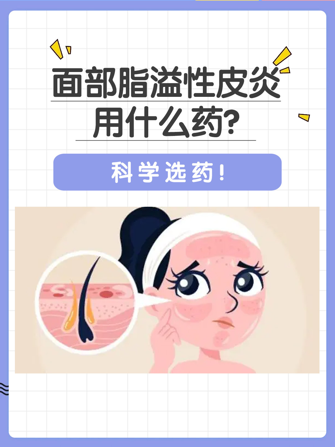 👉面部脂溢性皮炎用什么药？科学选药！