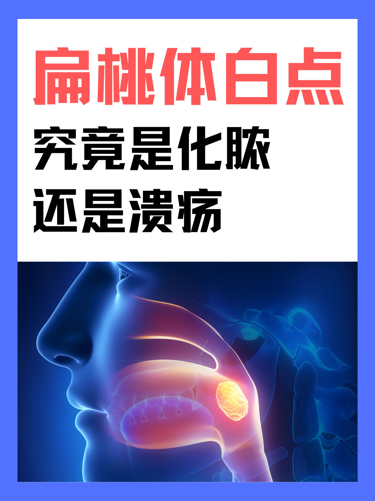 扁桃体白点究竟是化脓还是溃疡？揭秘扁桃体的小白点