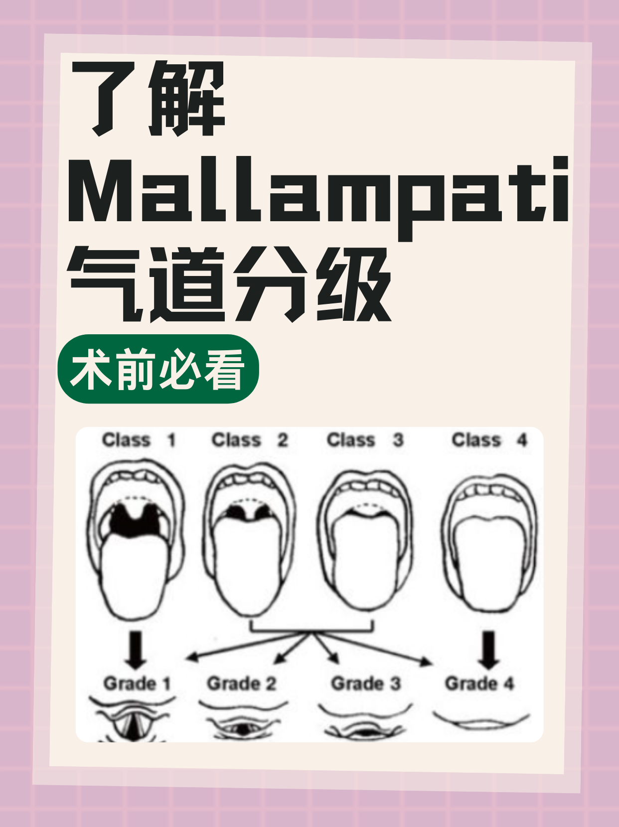 术前必看：了解Mallampati气道分级