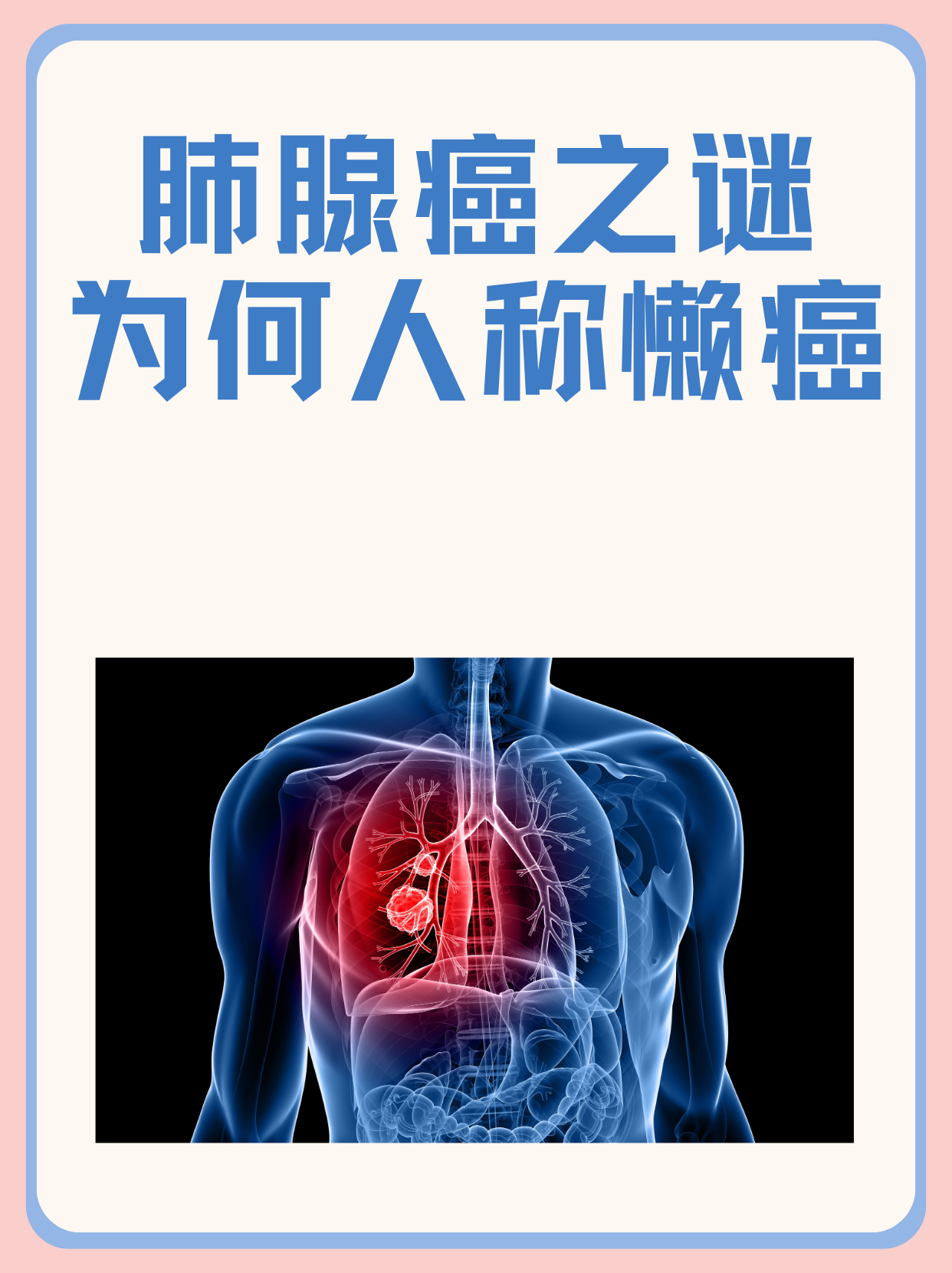 肺腺癌之谜，为何人称“懒癌”？