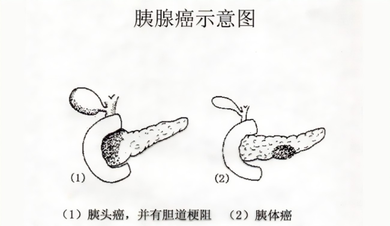 胰腺癌的治疗方法有哪些