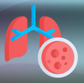 肺癌能早期发现吗
