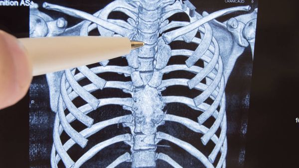 胸12椎体压缩性骨折多久能下床