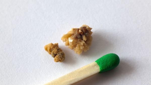 如何预防结石