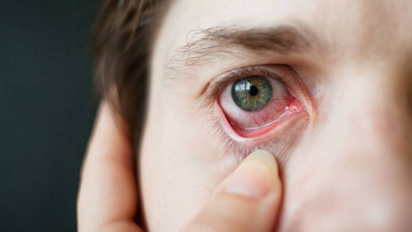 红眼病一般多久能好
