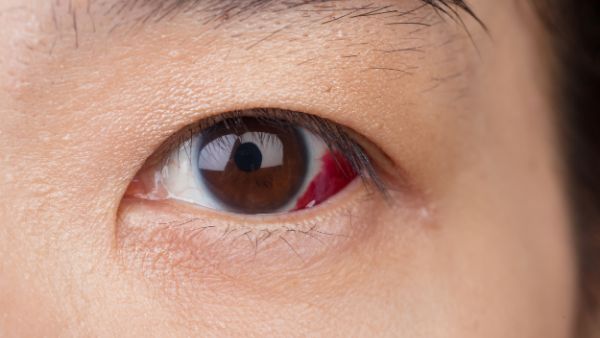 红眼病如何避免传染