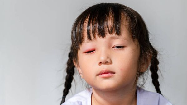 早起眼睑水肿怎么了