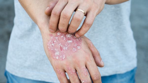 银屑病该怎么控制病情​