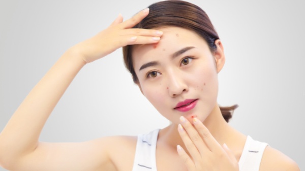 脸上长痘痘怎么办