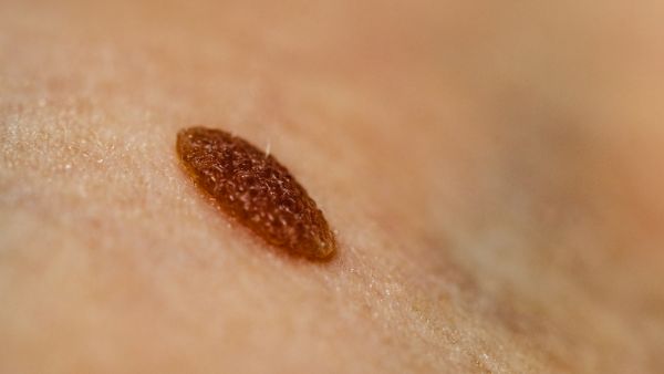 光泽苔藓的治疗策略有哪些