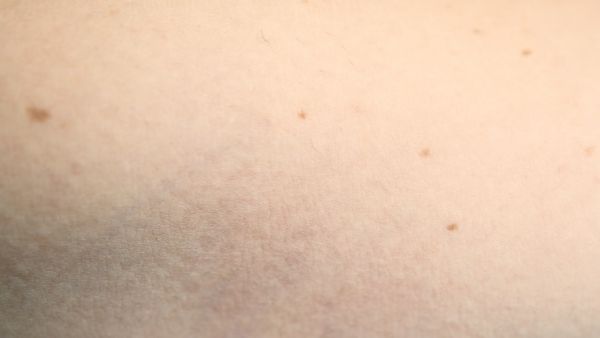 红斑狼疮四肢无力软怎么办