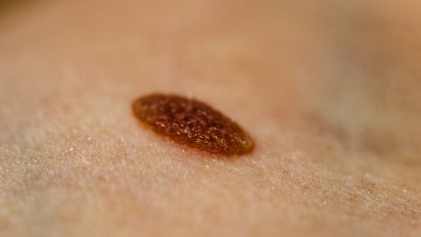 鲜红斑痣该怎么治疗