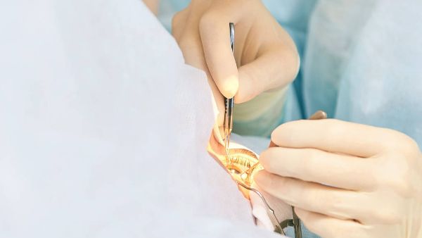 眼睛屈光不正是怎么回事