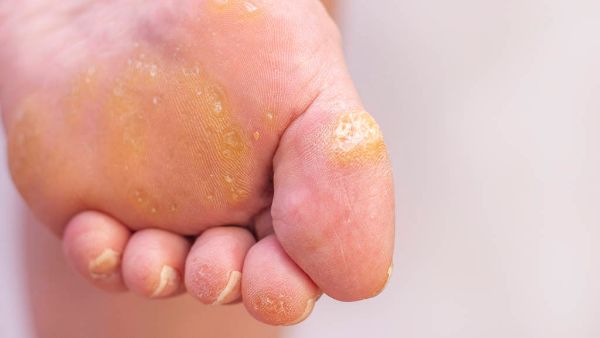 跖疣的治疗方法有哪些
