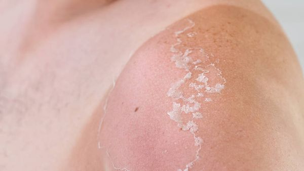 紫外线过敏起红斑怎么办​