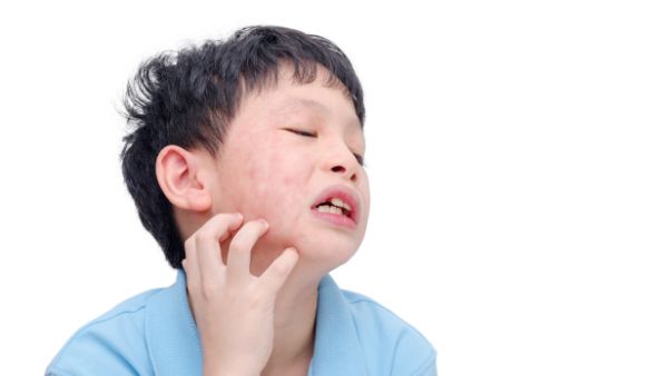 水上乐园过敏腿小疙瘩过敏怎么办