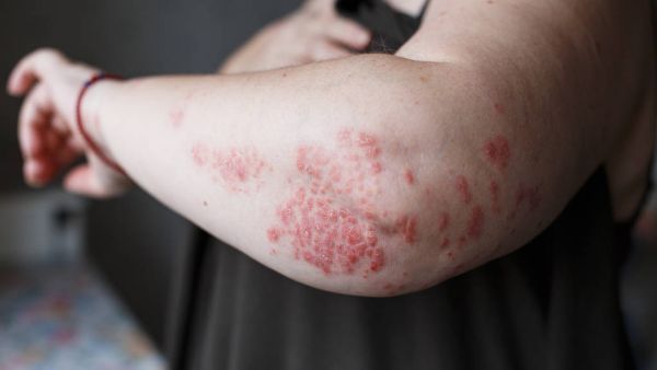 鱼鳞病有哪些症状​