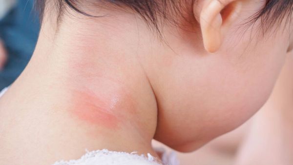 幼儿急疹高热期间如何正确护理