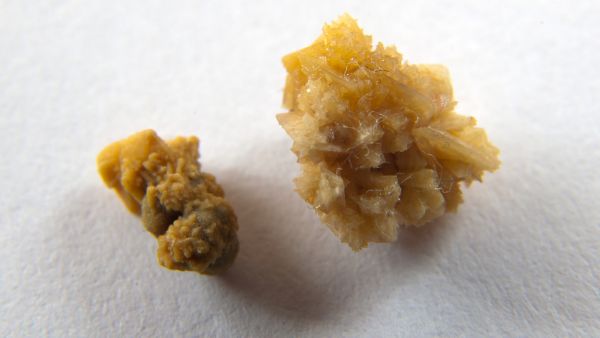 吃太多维生素C会得肾结石吗