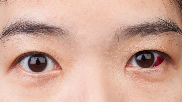 近视引起的玻璃体混浊怎么办