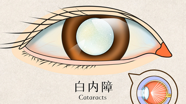 白内障手术后要戴墨镜吗