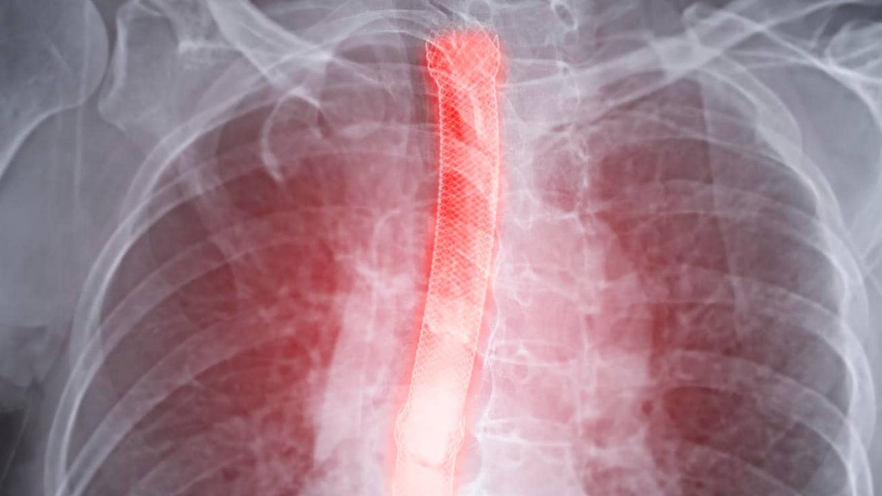 食道炎患者放射性疼痛怎么办