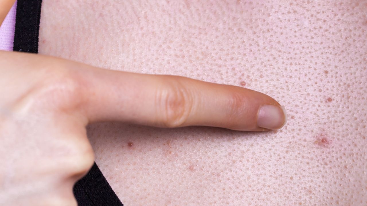 红斑狼疮病身上有黑点怎么办