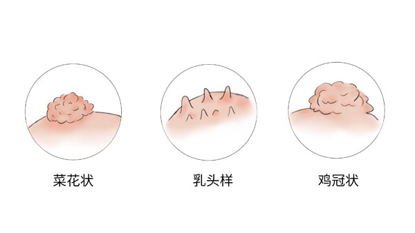 假尖锐湿疣症状是什么样子的