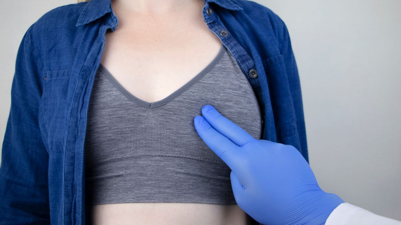 肉芽肿乳腺炎会变成乳腺癌吗