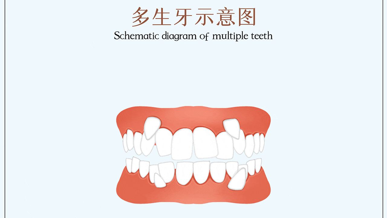 儿童多生牙怎么办​