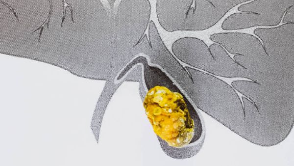 胆囊炎胆囊上有轻微的息肉该怎么治疗