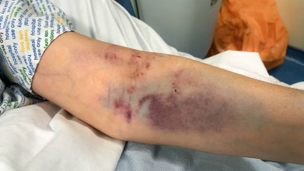 臂丛神经被压迫有哪些表现