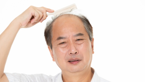 男士掉头发严重怎么回事
