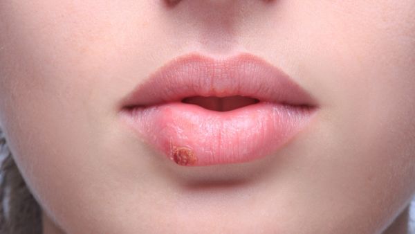 唇腺活检4个月后嘴唇麻木怎么了怎么办